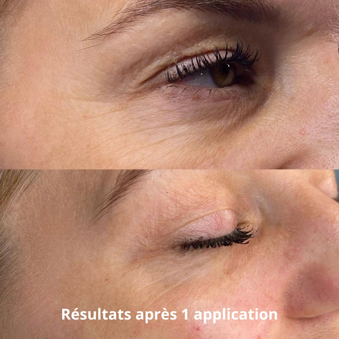 Patchs Regard Micro-Infusion Anti-Âge