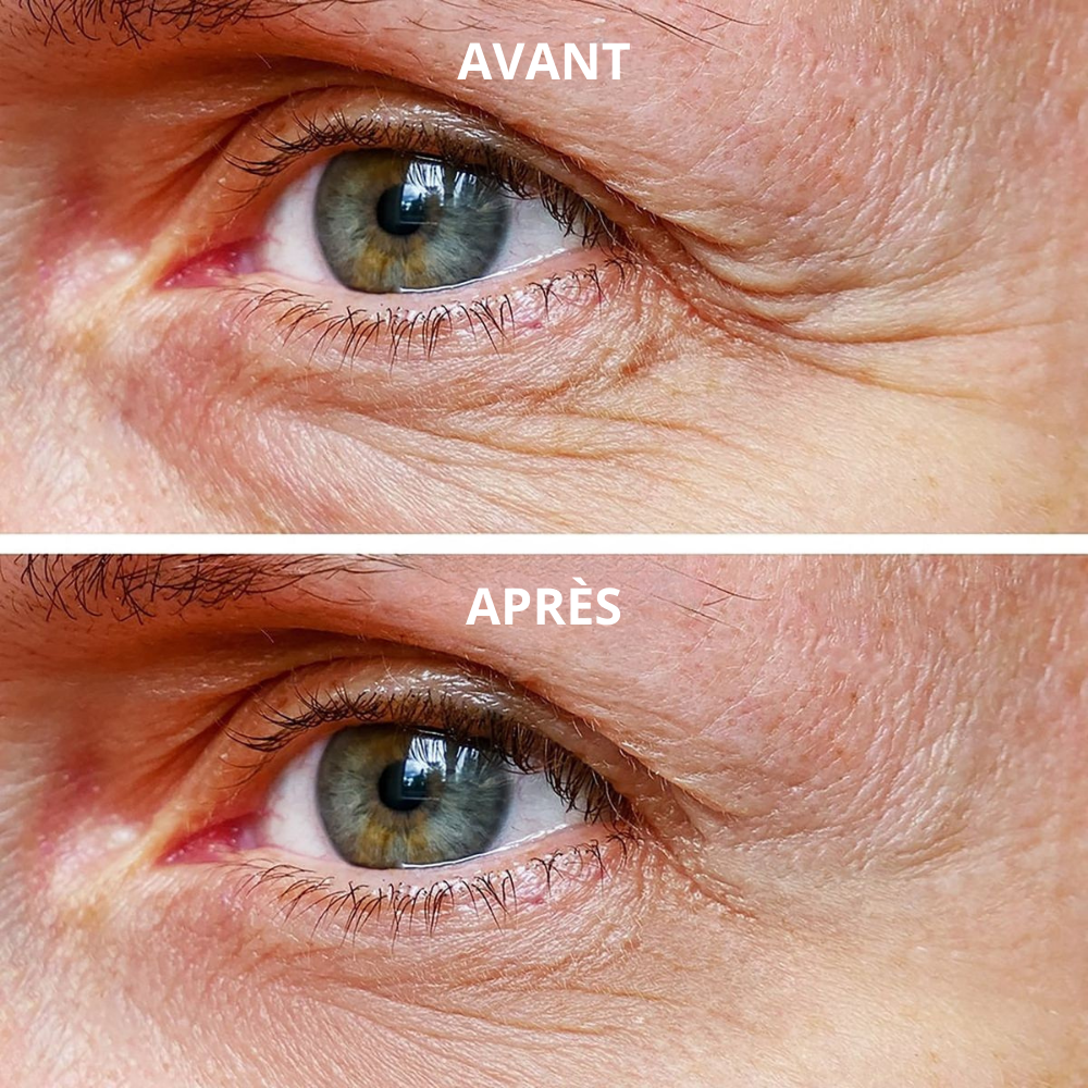 Patchs  micro-needling Acide Hyaluronique - Anti rides et ridules